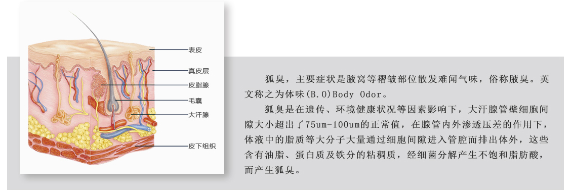  狐臭，主要症状是腋窝等褶皱部位散发难闻气味，俗称腋臭。英
                                                                    文称之为体味(B.O)Body Odor。
                                                                    　　狐臭是在遗传、环境健康状况等因素影响下，大汗腺管壁细胞间
                                                                    隙大小超出了75um-100um的正常值，在腺管内外渗透压差的作用下，
                                                                    体液中的脂质等大分子大量通过细胞间隙进入管腔而排出体外，这些
                                                                    含有油脂、蛋白质及铁分的粘稠质，经细菌分解产生不饱和脂肪酸，
                                                                    而产生狐臭。